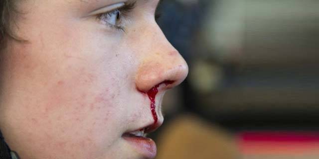 ناک سے خون کیوں بہتا ہے اور اسے کیسے روکا جائے؟